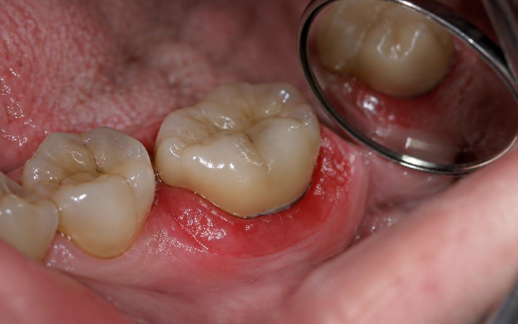 Dental Crown Infection Symptoms To Recognize
