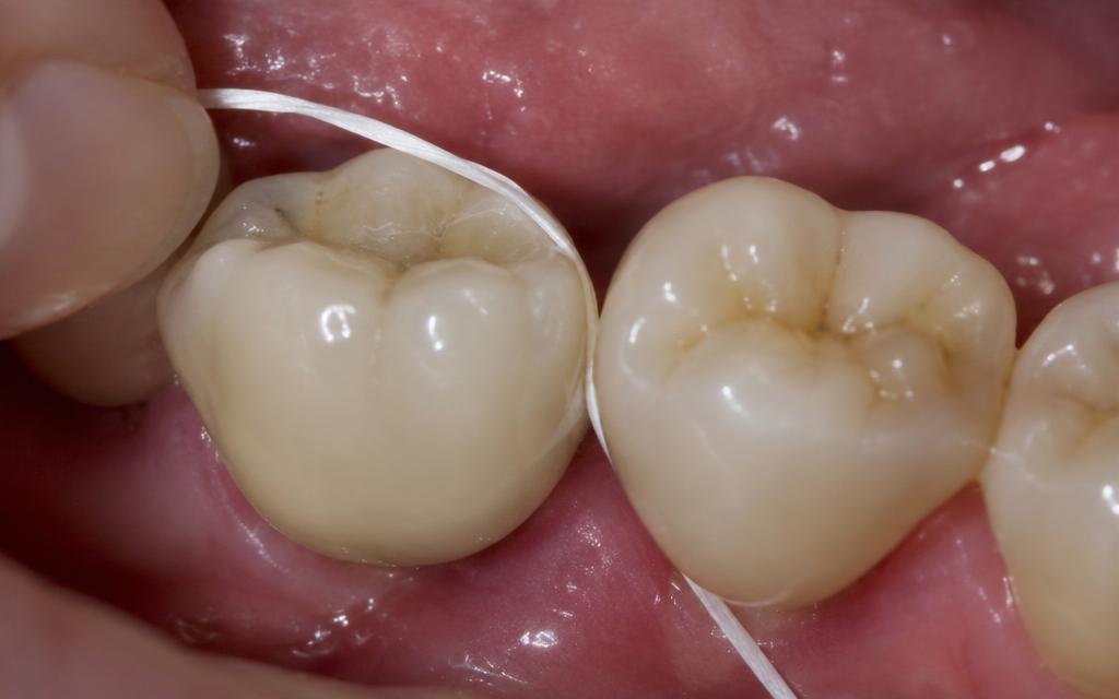 Watercolor-style comparison illustration showing a dental crown with normal healing and tight contact versus an open contact where food becomes trapped between the crown and adjacent tooth.
