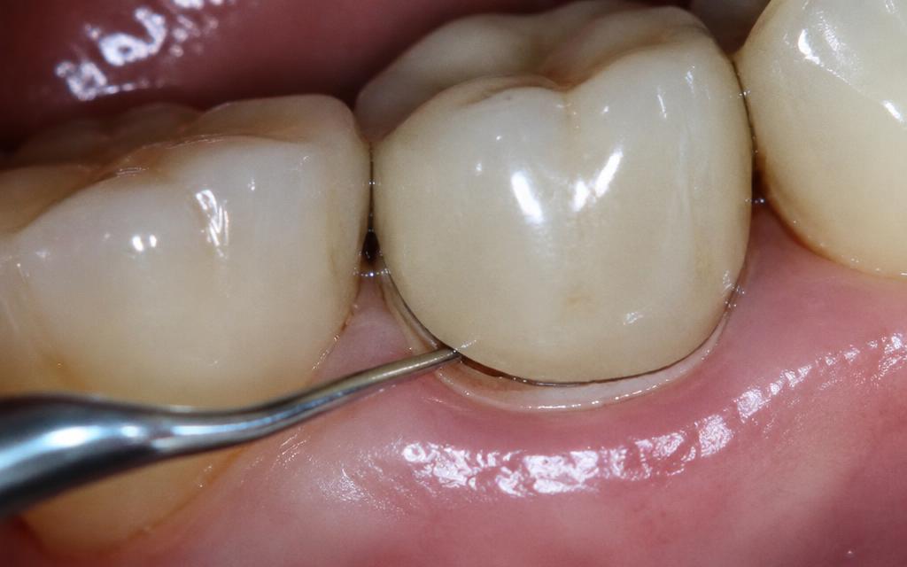 Open Margin On A Crown: What Causes It And When It Matters