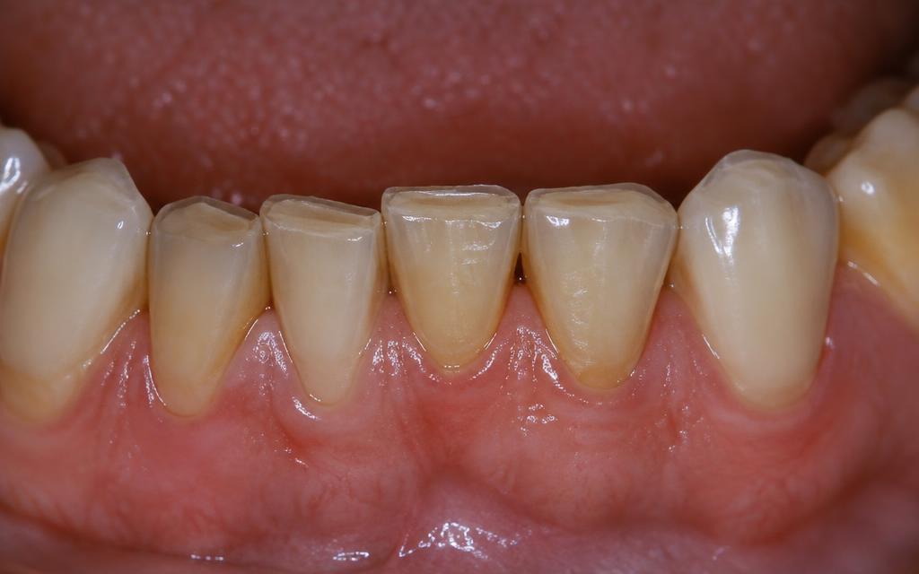 Profile view of a patient at rest with a transparent overlay showing jaw muscles, teeth, and temporomandibular joint, illustrating how clenching and grinding affect the jaw.