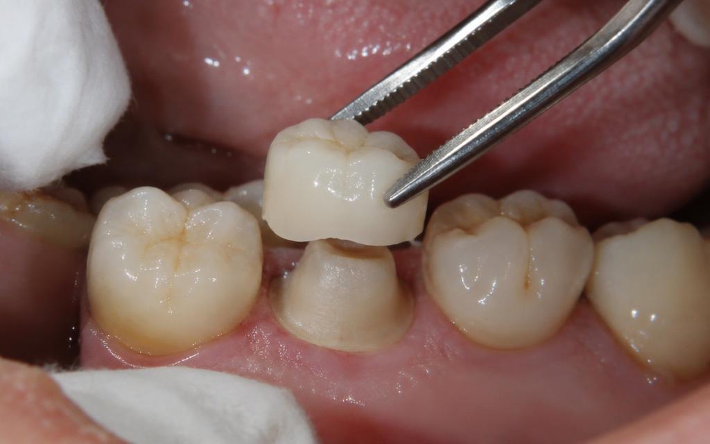 Watercolor-style illustration showing a posterior dental crown with articulating paper used to check bite contact, highlighting occlusal contact marks during crown adjustment.