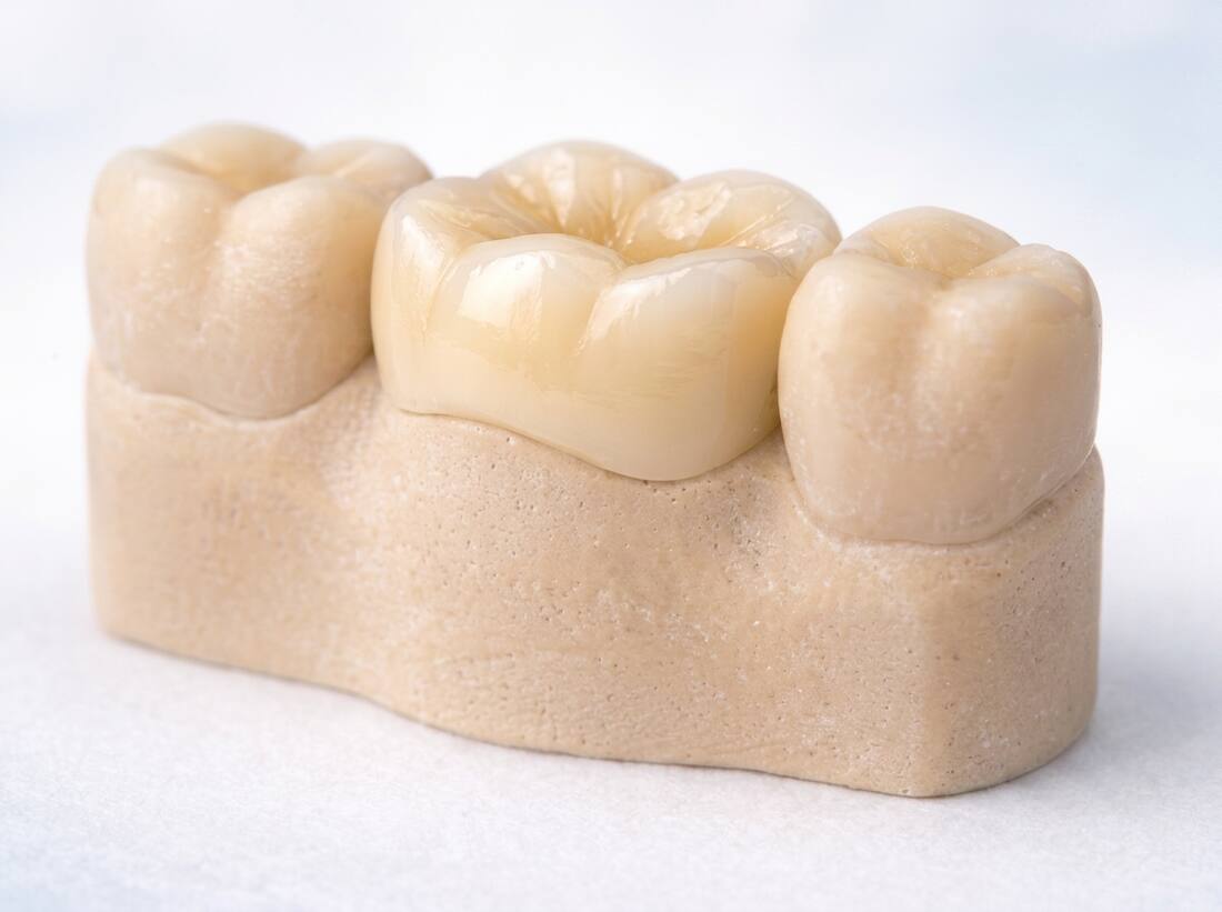 Prepared tooth and crown fit illustration