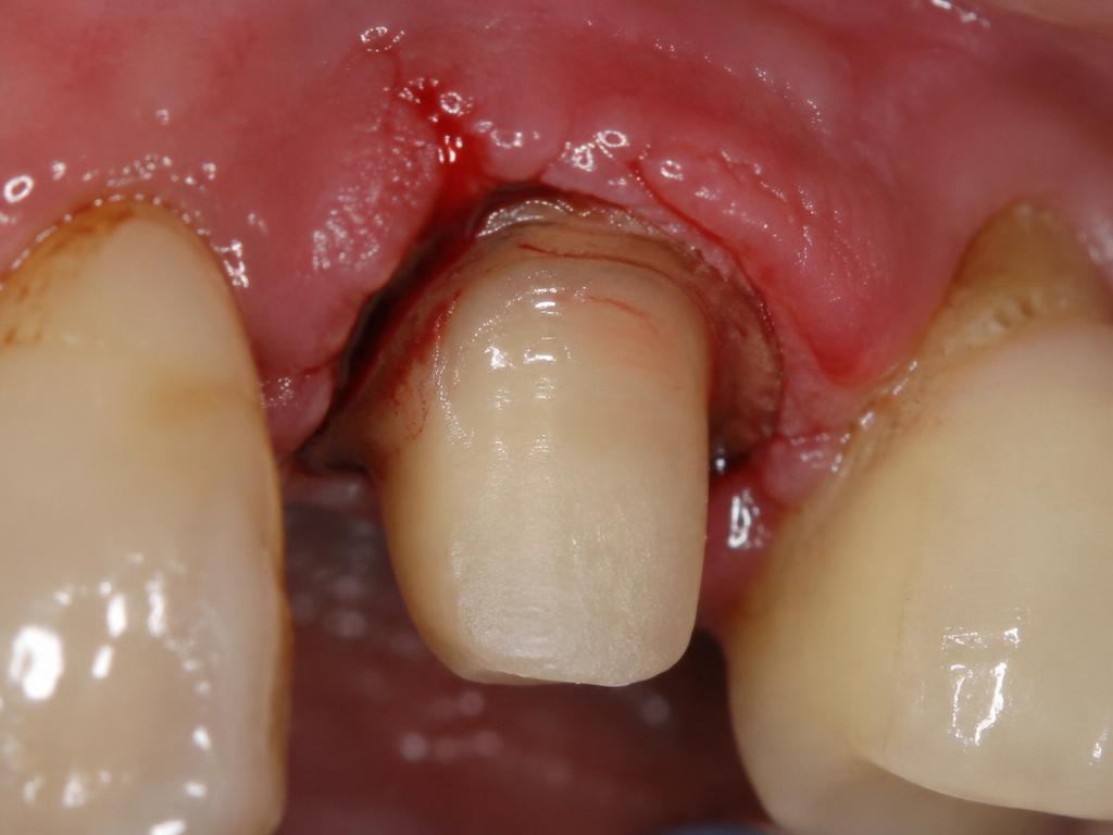 Crown — Unclear Margin