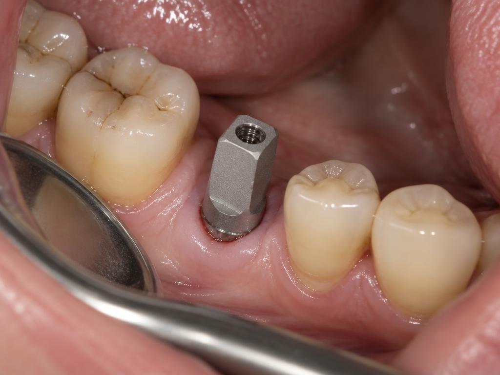 Implant Scanning